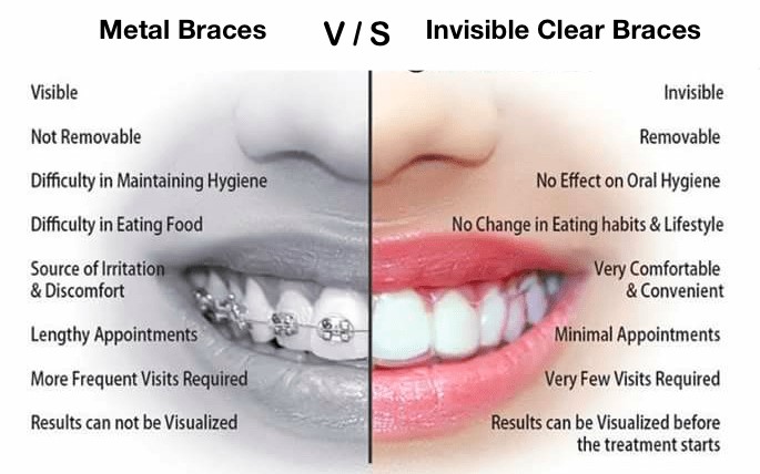 Benefits of Removal Braces