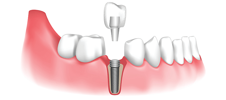 Dental Implant for Teeth