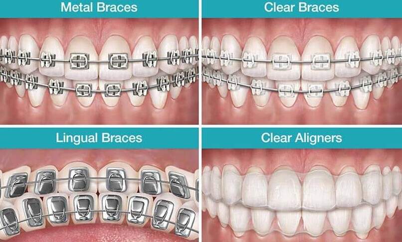 Different Type of Braces for Teeth Gap Filling