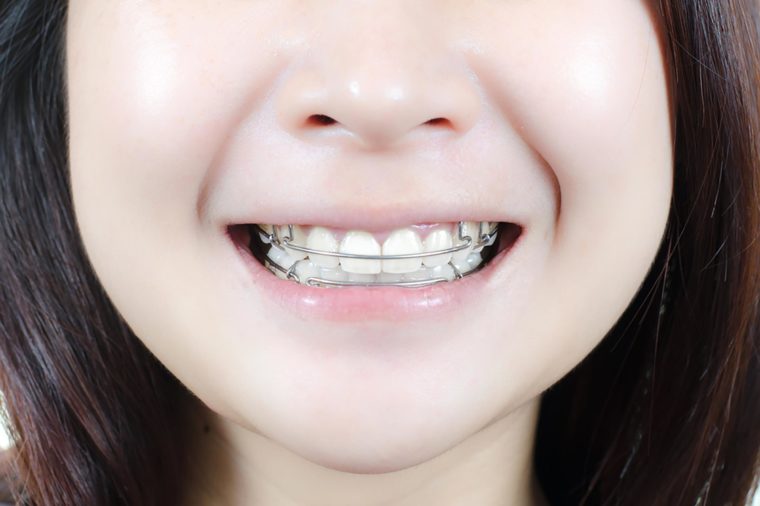 Removable Braces for Kid