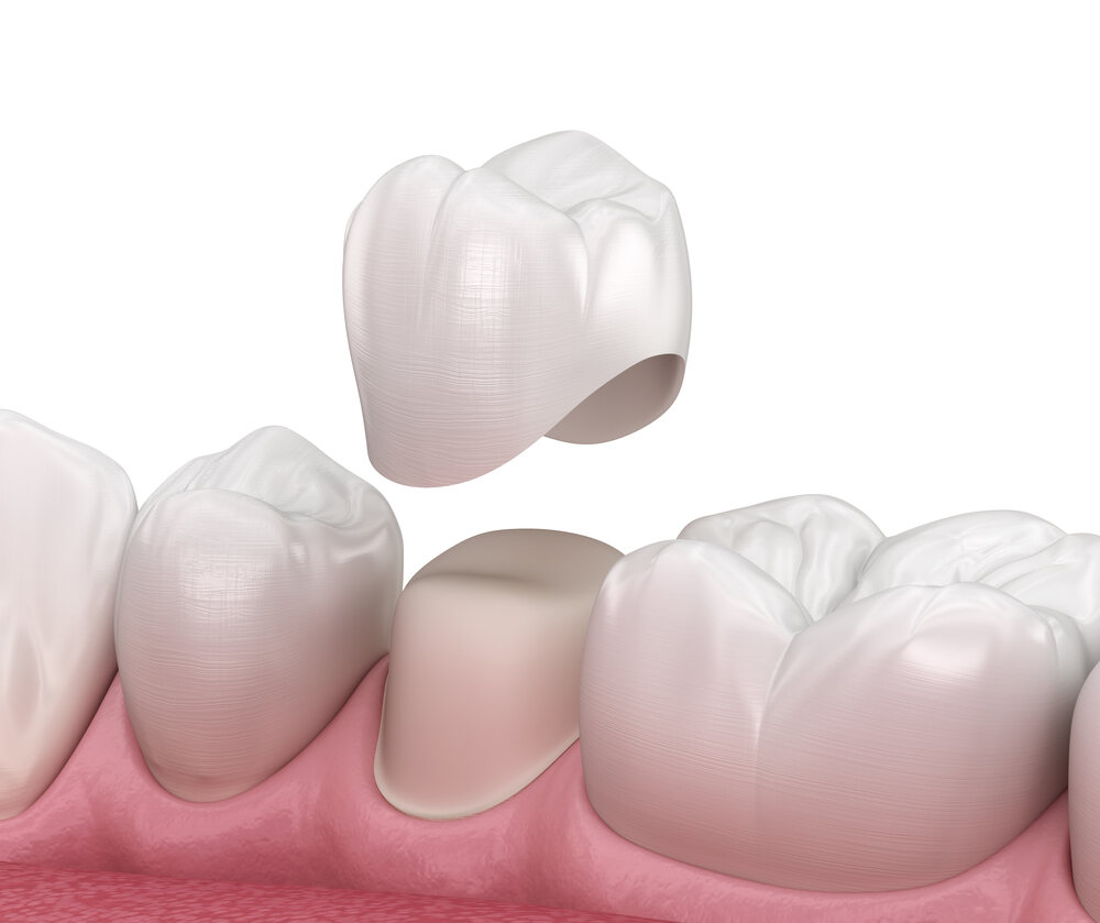 Dental Crown - Broken teeth treatment