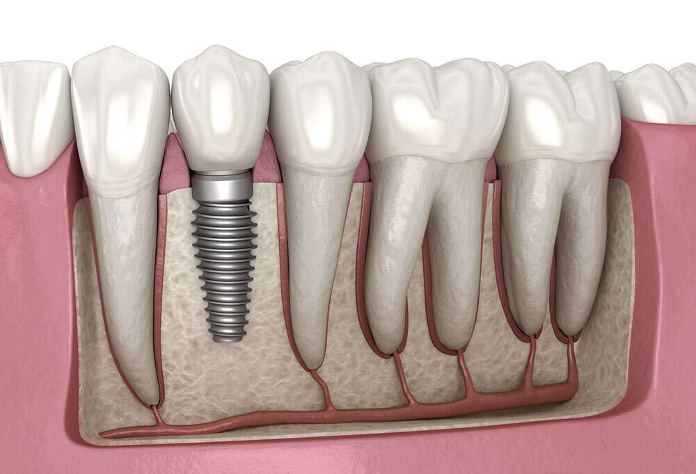 Dental-implant for teeth gap treatment