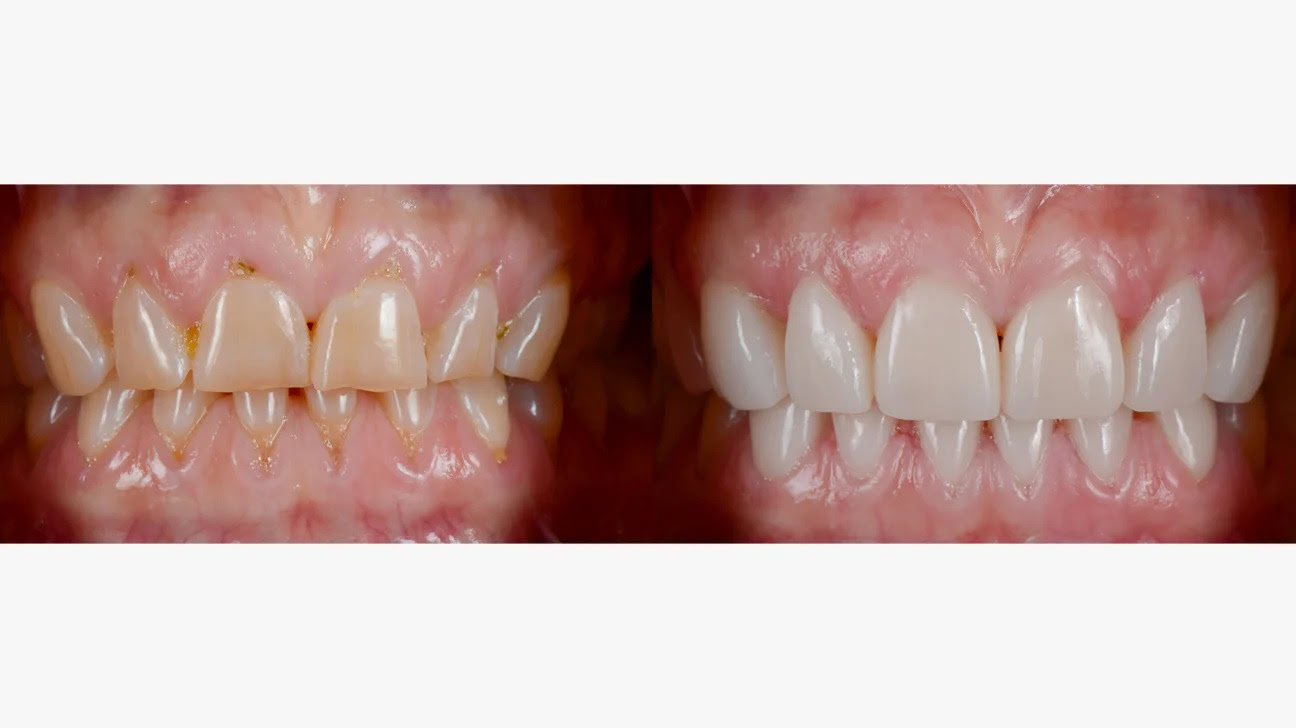 Dental-veneers for teeth
