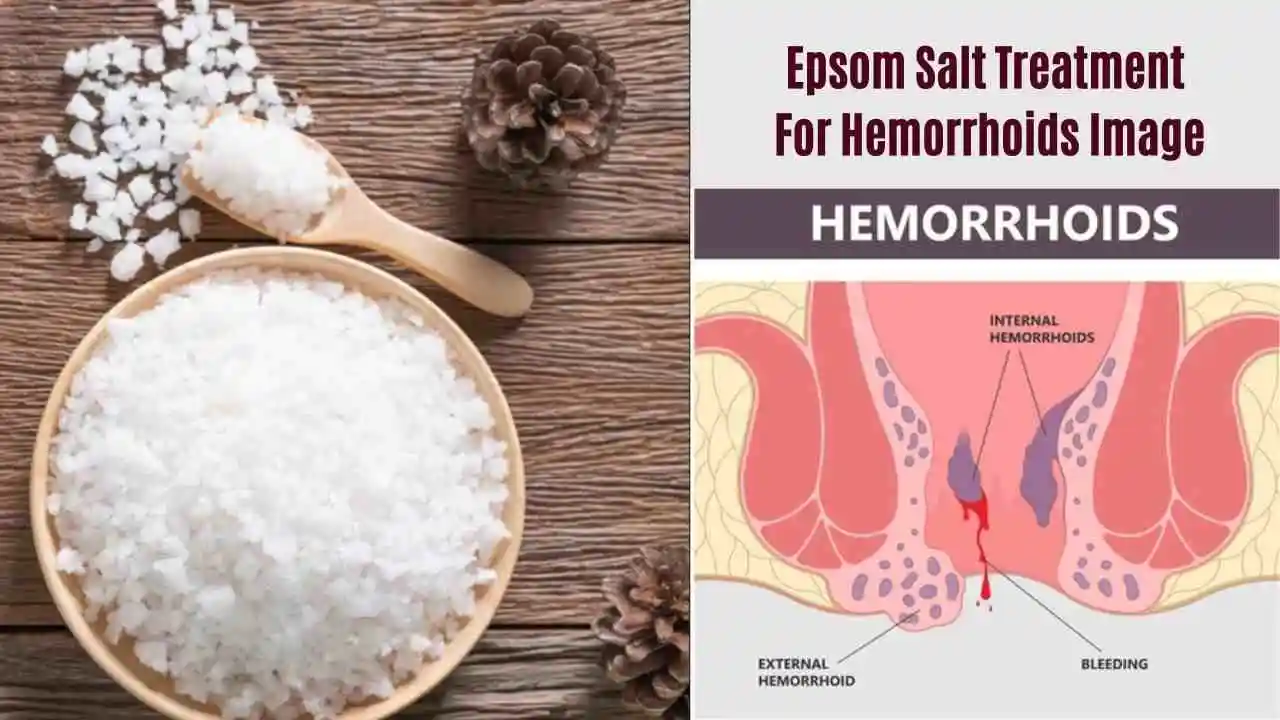 Epsom Salt For Hemorrhoids