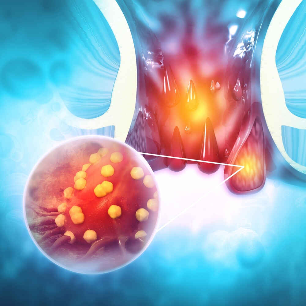 Haemorrhoids (piles) or Colon cancer 3d illustration Image