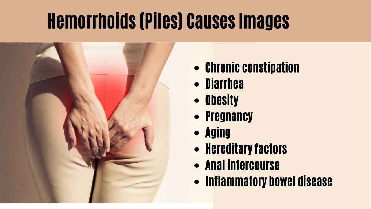 Hemorrhoids Causes Image