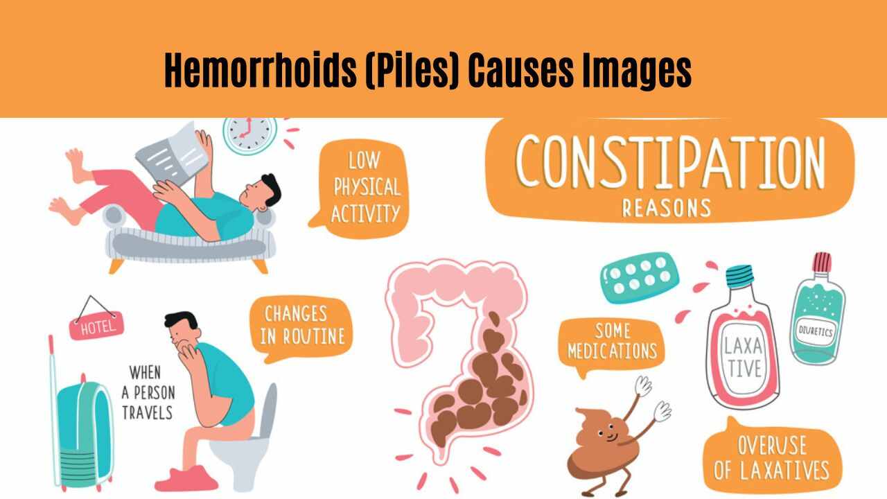 Hemorrhoids (Piles) Causes Images
