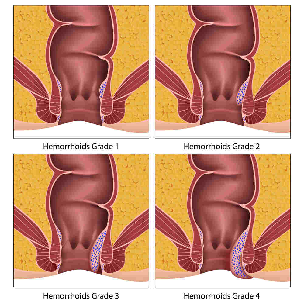 Hemorrhoids (Piles) Grades Image