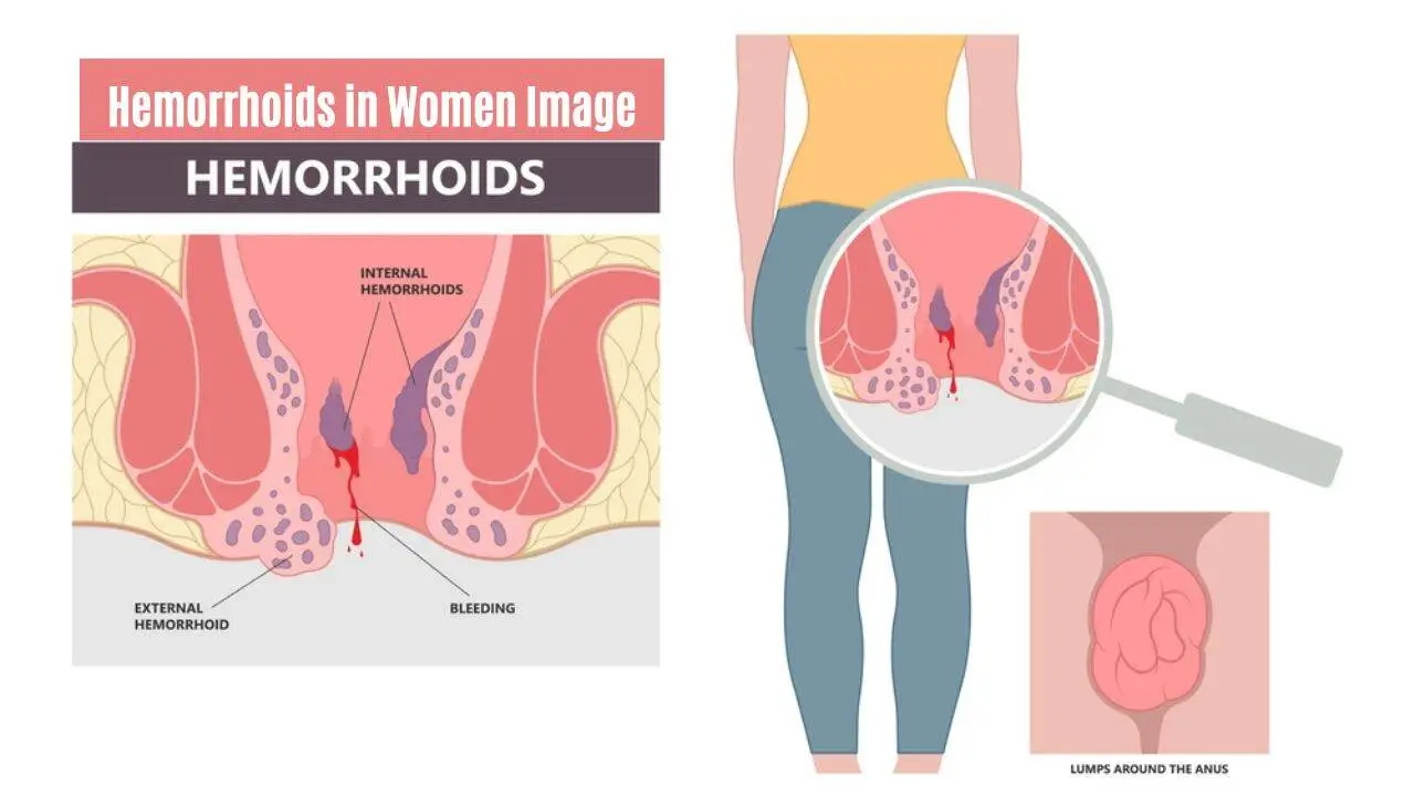 Hemorrhoids in Women Image