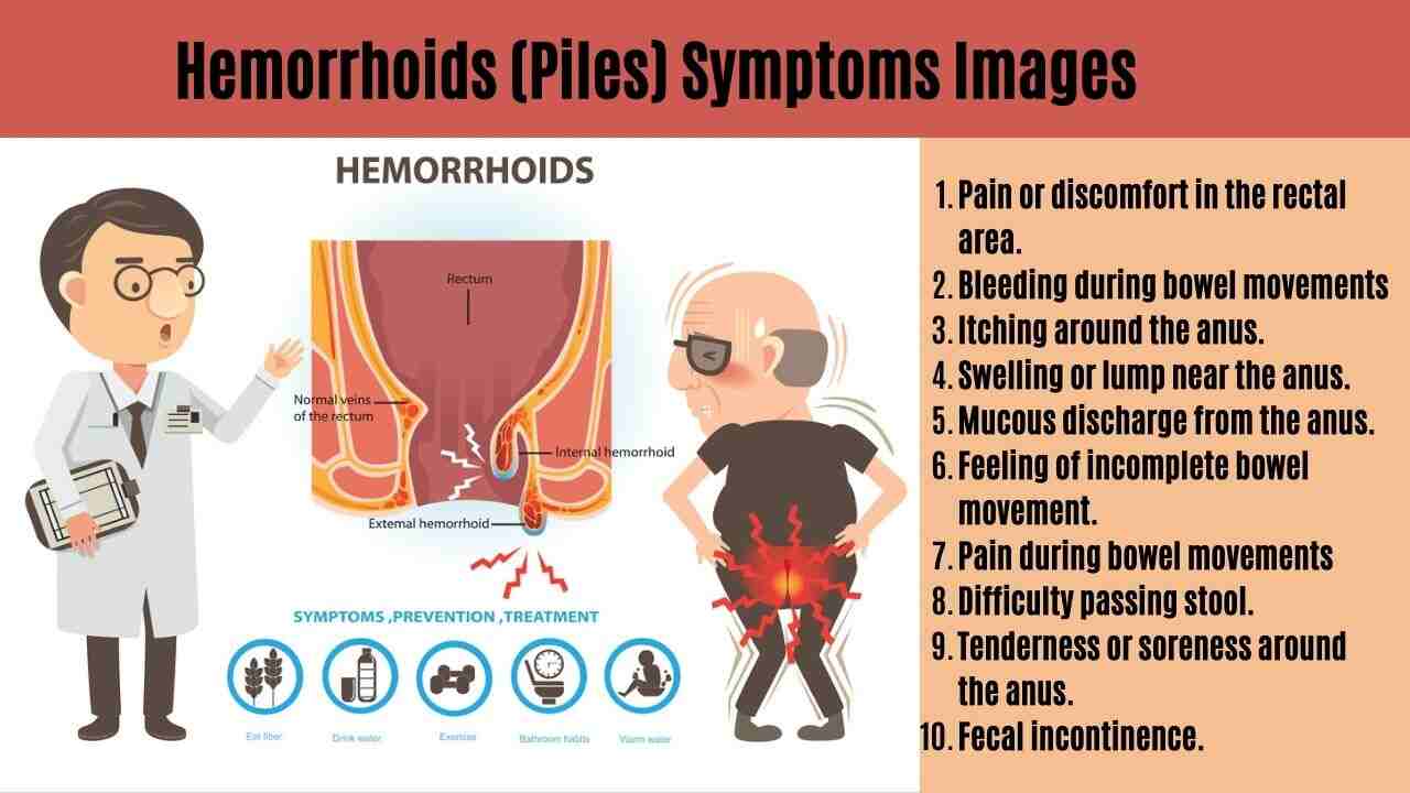Hemorrhoids (Piles) Symptoms Images