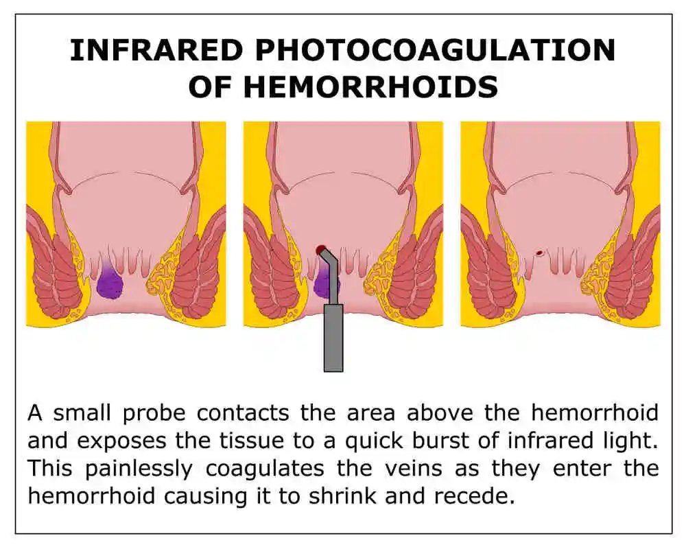 Infrared Photocoagulation of hemorrhoids image