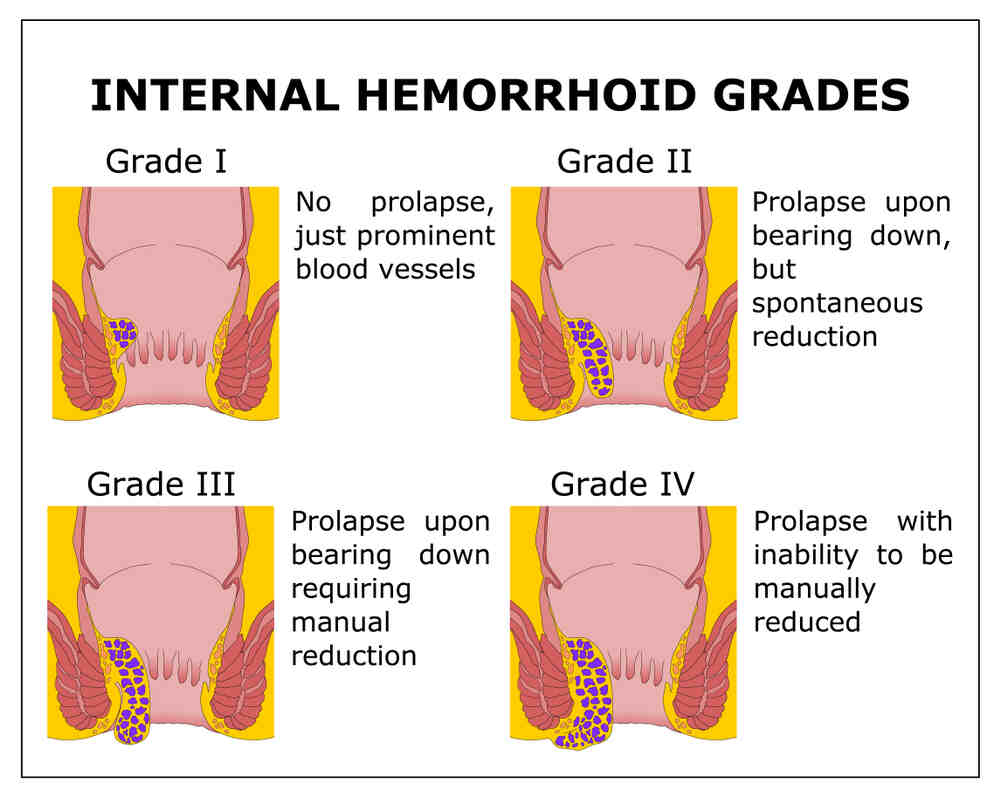 Internal and External Hemorrhoids Grades Image
