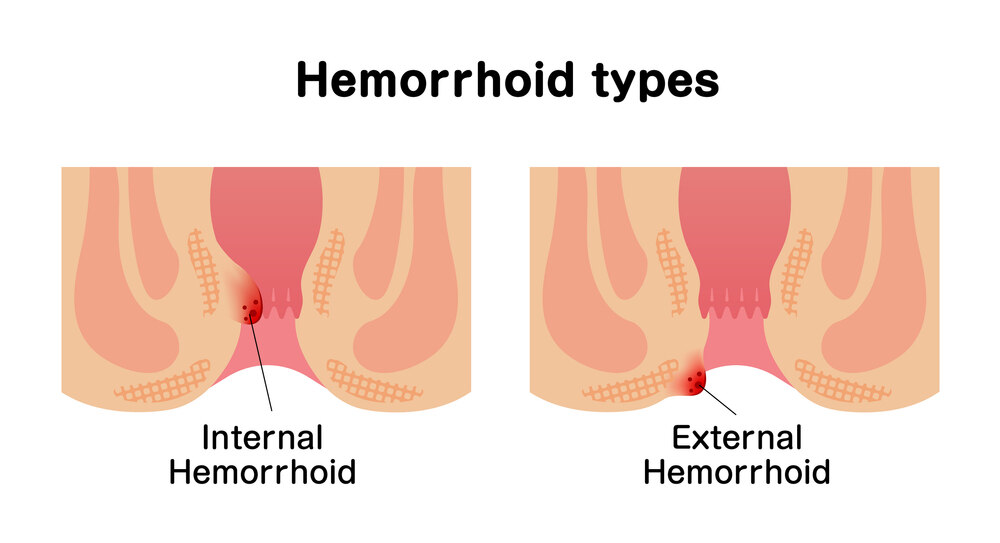 Internal and External Hemorrhoids Image