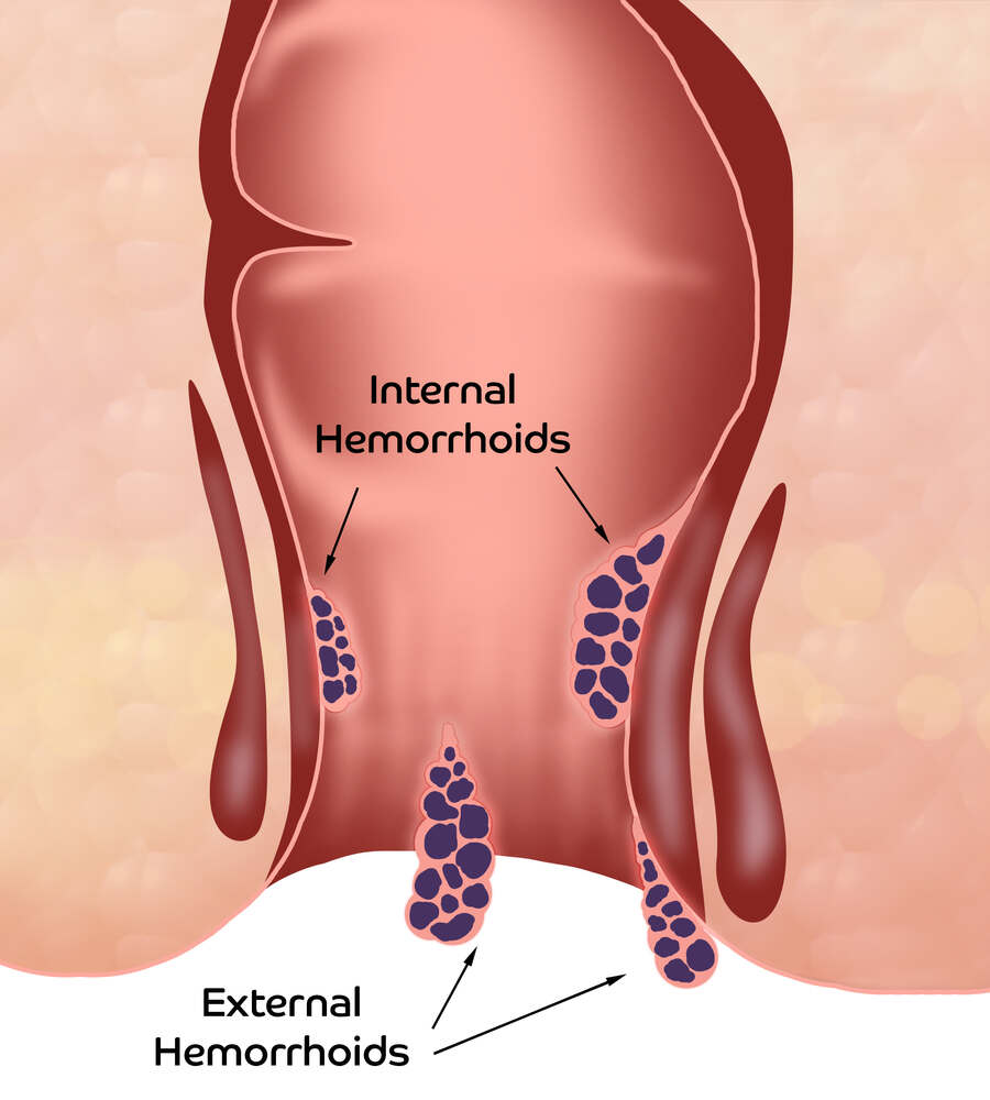 Internal and External Hemorrhoids (Piles) Image