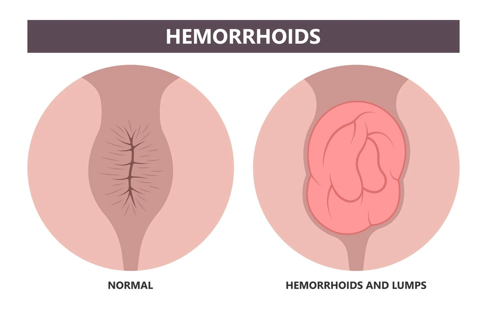 Normal Vs Hemorrhoids in Lumps Image