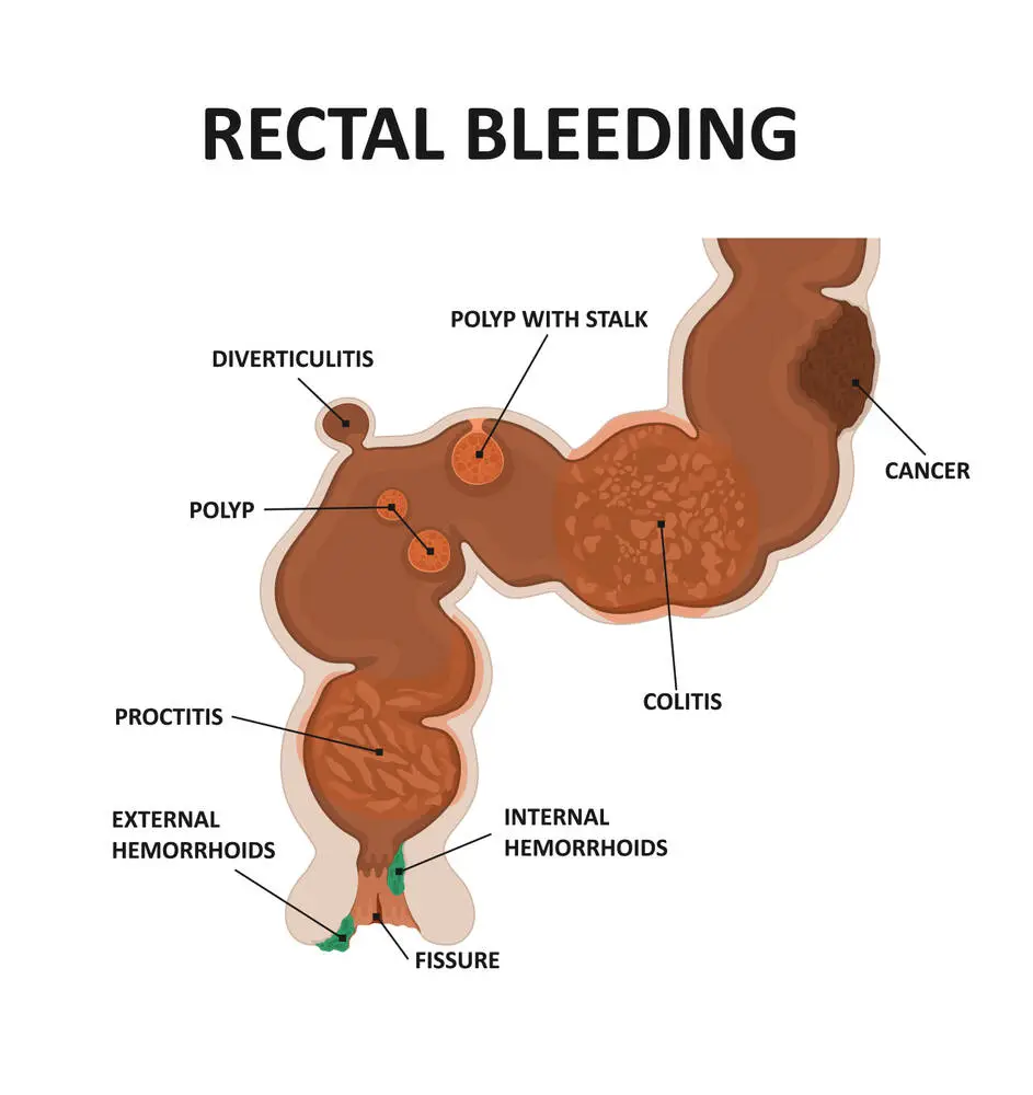 Rectal Bleeding Hemorrhoids Piles Image