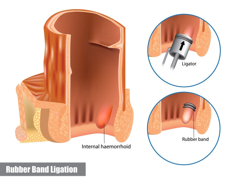 Rubber band ligation of hemorrhoid Image