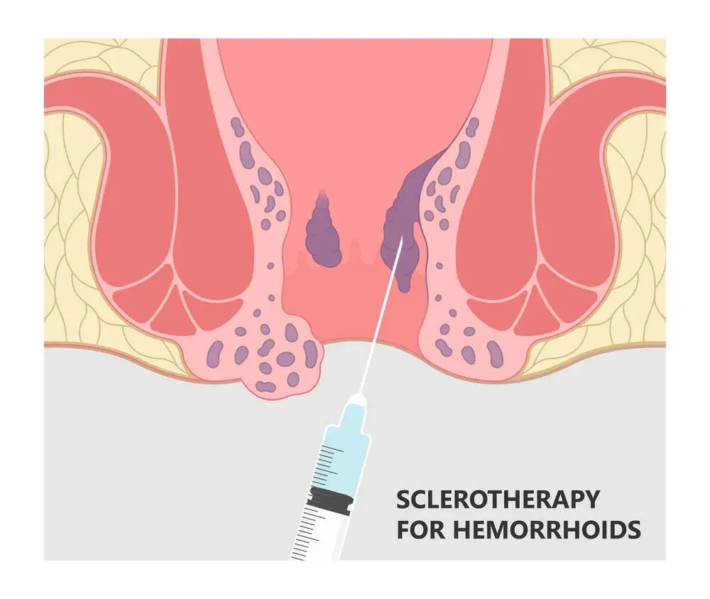 Sclerotherapy for hemorrhoids