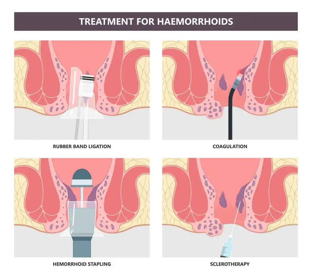 Treatment for Hemorrhoids Image