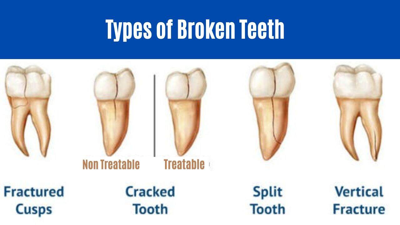 Types of Broken Teeth