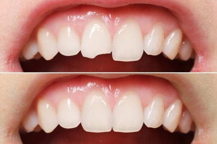 dental bonding for teeth gap treatment
