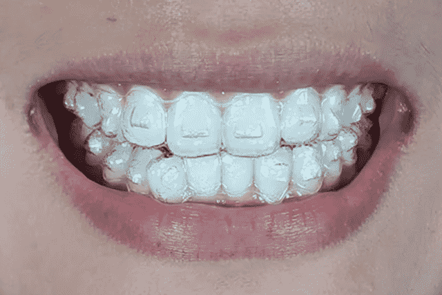 invisalign for teeth gap filling