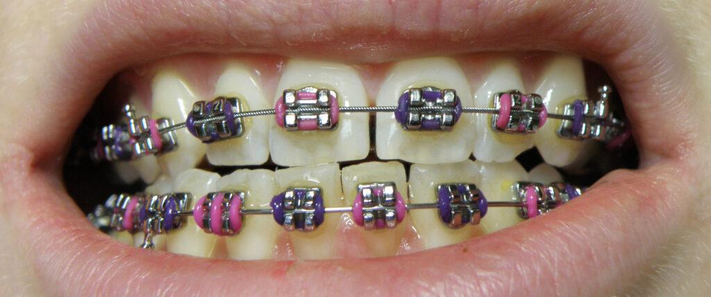 Braces on upper and lower teeth with detailed close-up view
