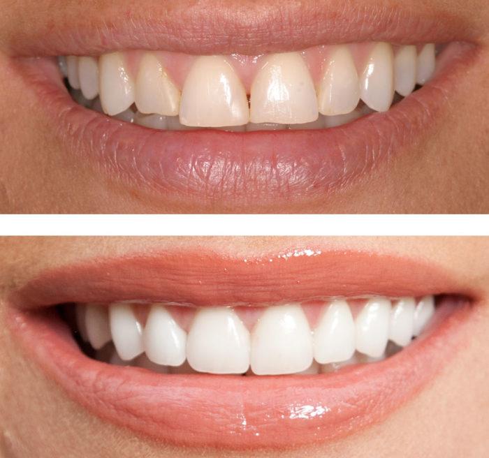 Dental bonding before and after comparison showing improved teeth appearance