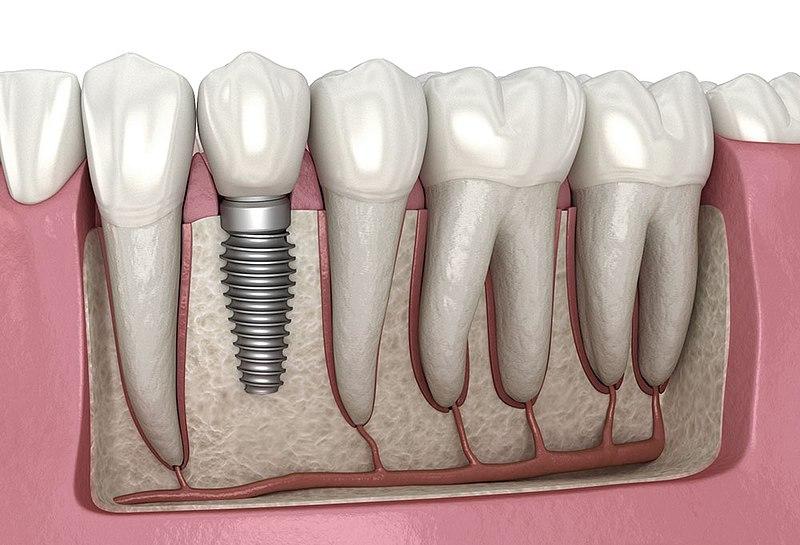 Dental implant diagram showing a single tooth replacement in the jawbone