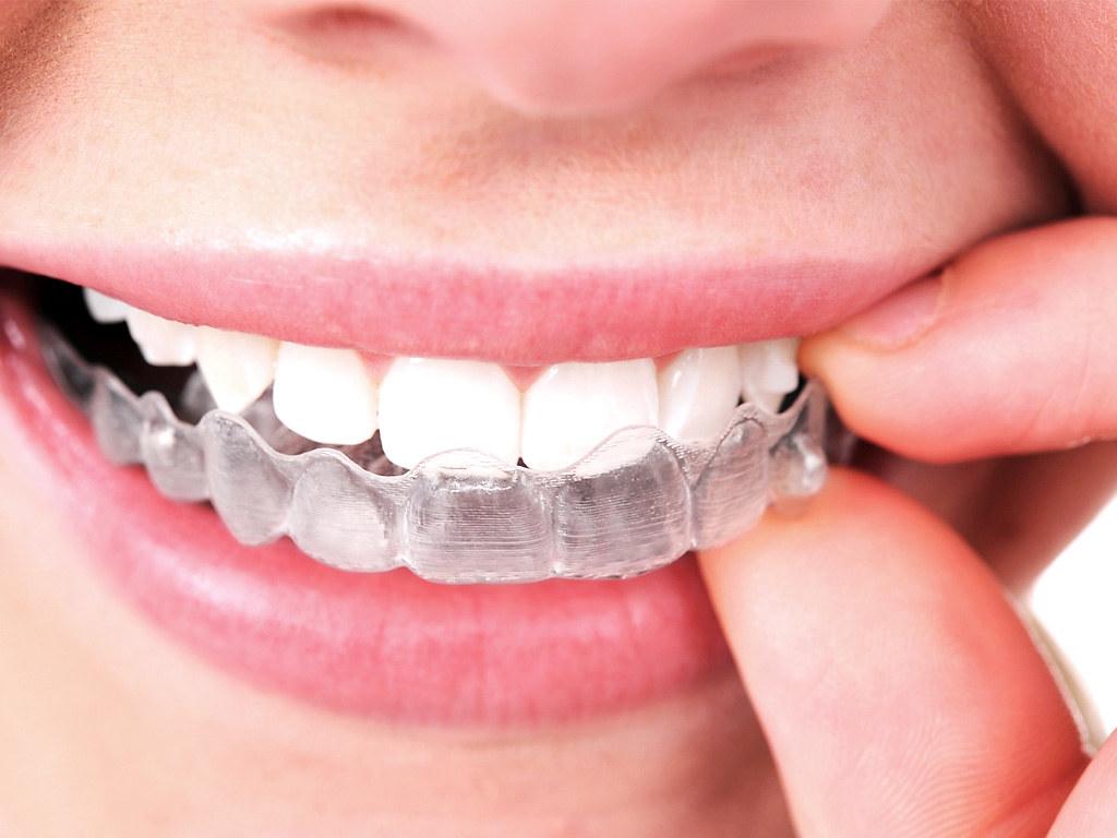 Invisalign clear orthodontic aligner being placed on teeth for dental correction