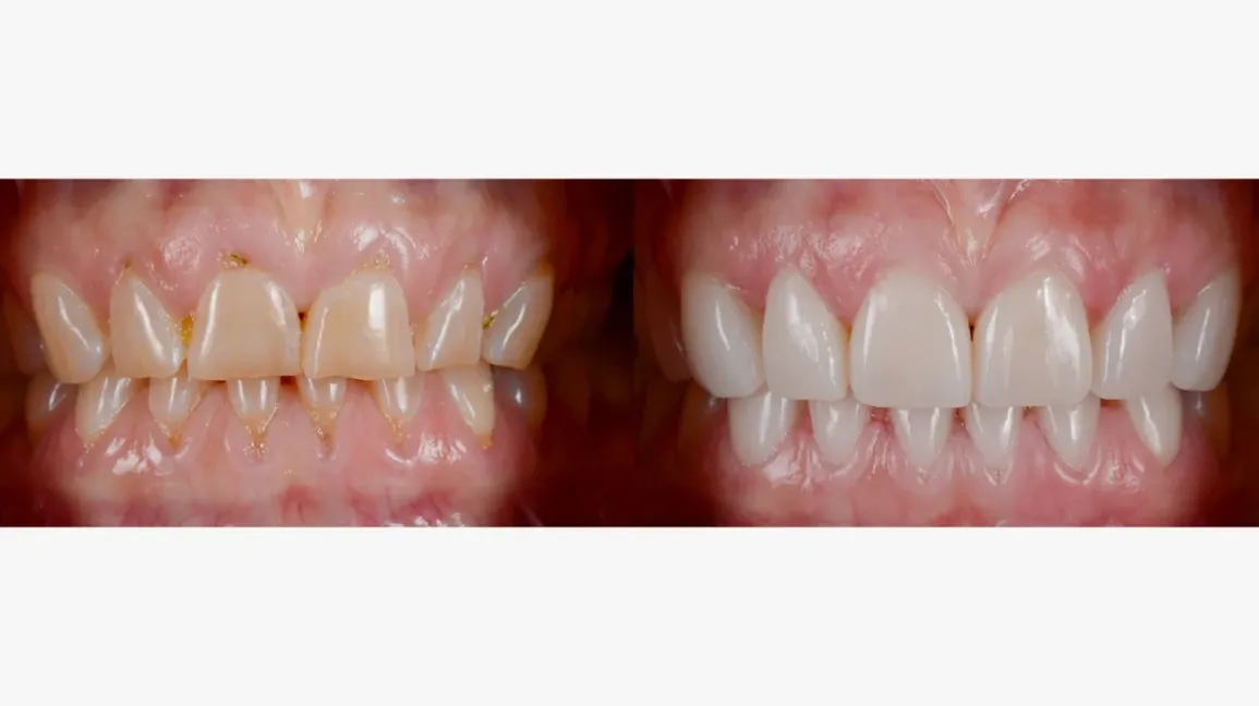 Veneers before and after transformation showcasing dental restoration and cosmetic improvement.
